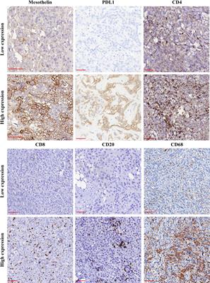 Mesothelin expression remodeled the immune-matrix tumor microenvironment predicting the risk of death in patients with malignant pleural mesothelioma